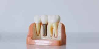 How Should You Prepare for a Dental Implant? The Essential Guidelines to Follow