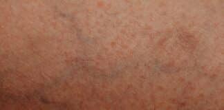 Does Insurance Cover Vein Treatment? What Patients Need to Know Human skin with visible texture and veins, showcasing natural patterns